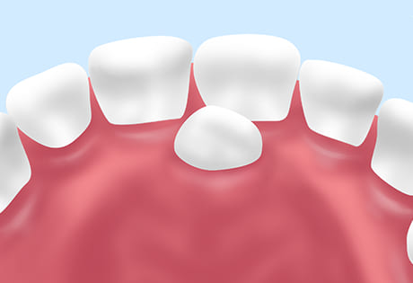 過剰歯の抜歯・晩期残存乳歯の抜歯